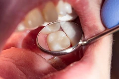 Penambalan Composite Kompleks di A+ Dental Care