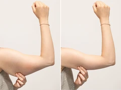 RF Lengan/Perut/Paha 3x di Klinik Ozthetique Jakarta
