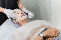 Peeling di Klinik Ozthetique Jakarta