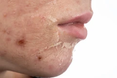 Acne Injection / 0.1cc di Klinik Ozthetique Jakarta