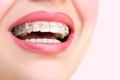 Pasang Behel Saphire oleh drg. Umum di Mydents