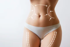 RF Shaping Tummy di YLA by dr. Sylvienia