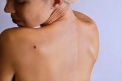 Mole Removal Light di YLA by dr. Sylvienia