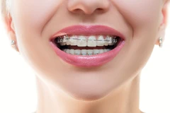 Pasang Behel Metal oleh drg. Umum di AM Dental Care