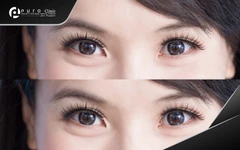 HIFU Eyes di Puro Clinic