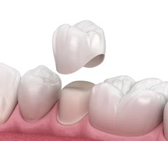 Pemasangan Gigi Palsu Crown Lengthening di Ada Dokter Gigi