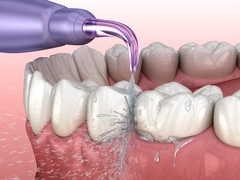 Scaling Gigi di Kala Dental Studio