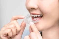 Pemasangan Clear Retainer di Kala Dental Studio