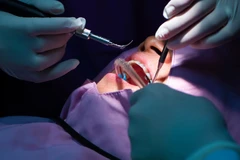Stain Removal di Kala Dental Studio