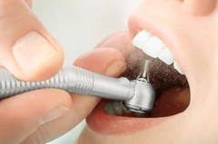 Stain Removal di Ananta Dental