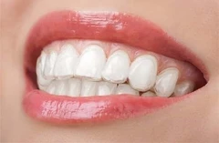 Splinting Wire per Gigi Goyang di Ananta Dental