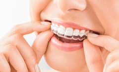 Retainer Permanen Per Rahang di Ananta Dental