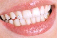 Diamond Teeth di Ananta Dental