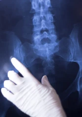 Pemeriksaan Osteoporosis Paket Basic (2 Tes) di KALGen Innolab