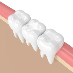 Tambal Gigi di Kini Dental
