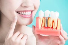 Implan Gigi oleh drg. Spesialis Prostodonsia Bedah Mulut di Kini Dental