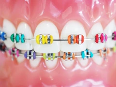 Pasang Behel Metal Anak 1 Rahang di Klinik Gigi Ammyn Sukabumi