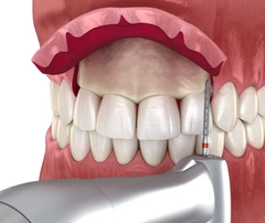 Gingivektomi per Rahang di CS Dental
