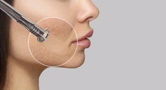 Fractional Scar Beauty di Beautify Indonesia