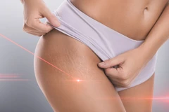 Fractional Stretch Mark di Beautify Indonesia