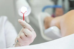 Pasang IUD di RS Kartika Husada Setu