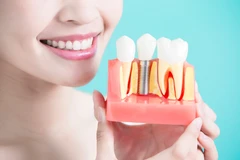 Implan Gigi di Umma Dental
