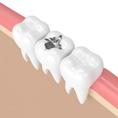 Gigi Palsu Metal di Umma Dental