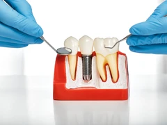 Sementasi Gigi di Umma Dental