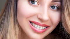 Pasang Behel Metal USA di Halo Dentist