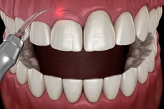 Gingivektomi 6 Gigi di Halo Dentist