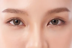 Blepharoplasty Upper & Lower dengan Anestesi Lokal di BIMC Hospital Nusa Dua