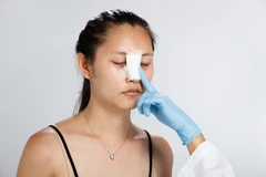 Operasi Hidung Sederhana Tanpa Implan di BIMC Hospital Nusa Dua