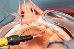 Kontrol Behel Konvensional (dengan karet) di RRDC Dental Care