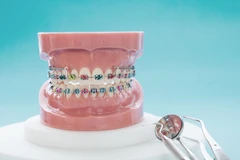 Kontrol Behel Self Ligating Damon oleh drg. Umum di Passion Dental Care