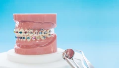 Pasang Behel Ceramic Sapphire oleh drg. Umum di Passion Dental Care