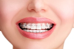 Pasang Behel Self Ligating Easy Clip oleh drg. Umum di Passion Dental Care