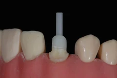 Pemasangan Pasak Dentin oleh drg. Umum di Passion Dental Care