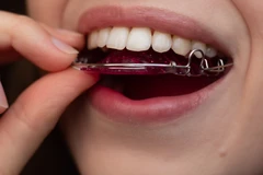 Ortodonti/Kawat Lepasan dan Rentainer Per Rahang oleh drg. Umum di Passion Dental Care