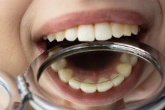 Pemasangan Rubber Dam drg. Umum di Passion Dental Care