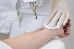 Premium Laser Tatto Removal di Indria Beauty