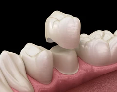Pemasangan Crown Porcelain di Indria Medicare