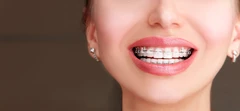 Pasang Behel Gigi Ceramic oleh drg. Umum di Yanda Dental Care