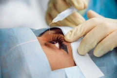 Tindakan ICL Toric 1 Mata di Klinik Utama JHC (Kardia Eye Center)