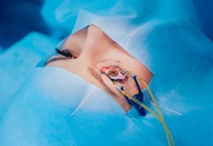 Tindakan Iridectomy di Klinik Utama JHC (Kardia Eye Center)