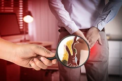 Tindakan Ambeien dengan Flash Optical Laser di RSIA Mama Palembang (VWC)