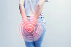 Tindakan Ambeien Internal 4 Titik dengan Metode Ikat Well-C di Vena Wasir Center Gading Serpong