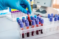 Pemeriksaan Fibrinogen di Klinik Galaxy Medical Center