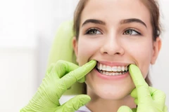 Direct Veneer di Care Clinic