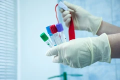 Pemeriksaan Endokrin Testoteron total di Klinik Lina Lica