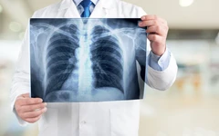 Rontgen Vertebrae Lumbal 2 Posisi (Ap & Lat) di AIC Medical Clinic